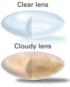 cataract clear and cloudy lenses