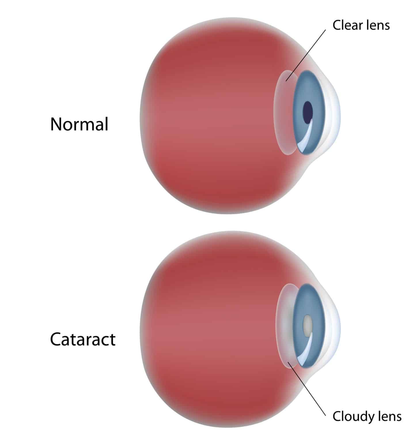 Lens Implants for Cataract surgery You have choices! Jahnle Eye