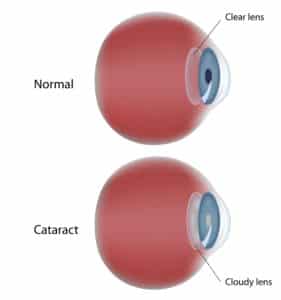 cataract vs clear lens