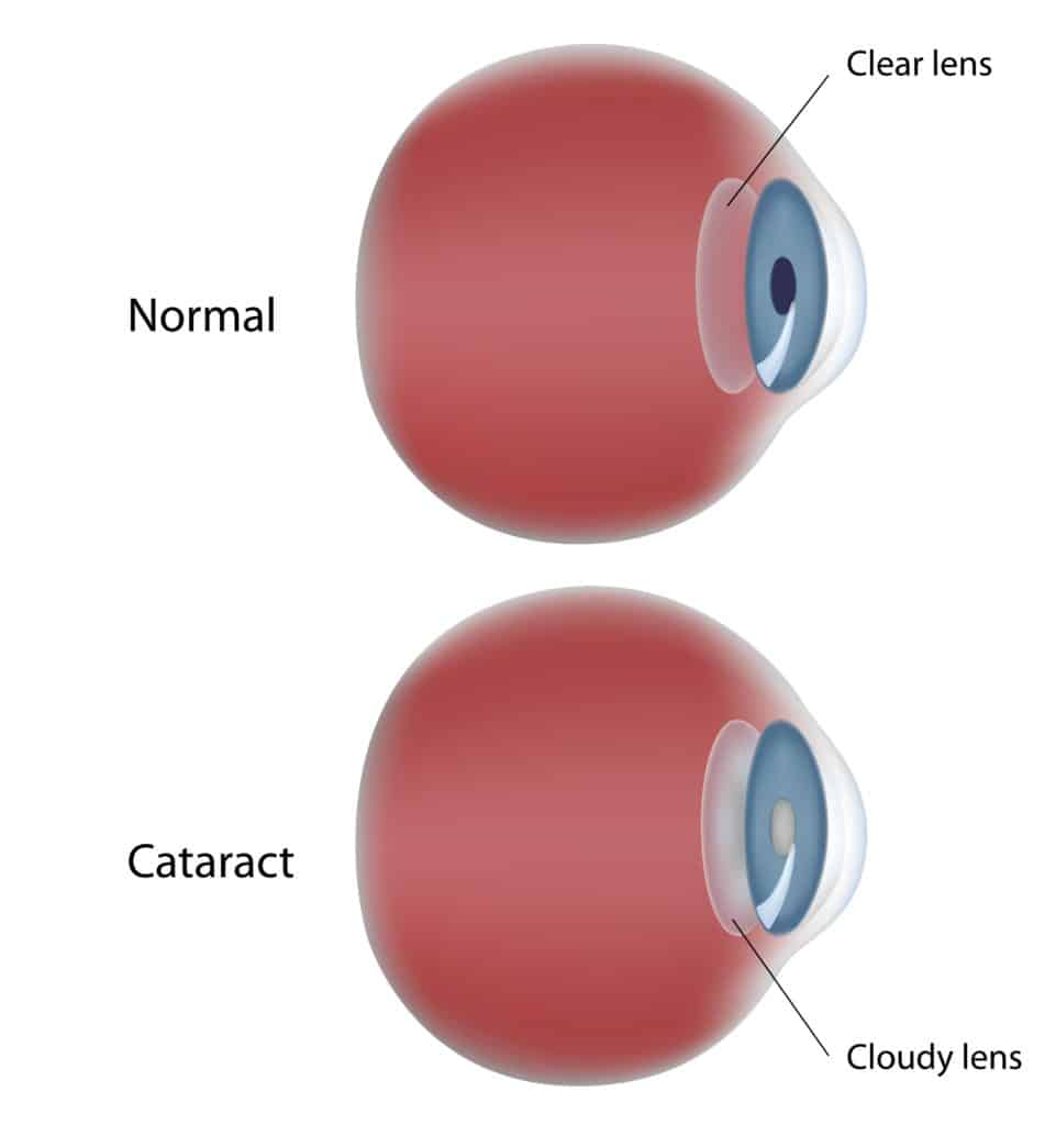 Lens Implants for Cataract surgery You have choices! Jahnle Eye